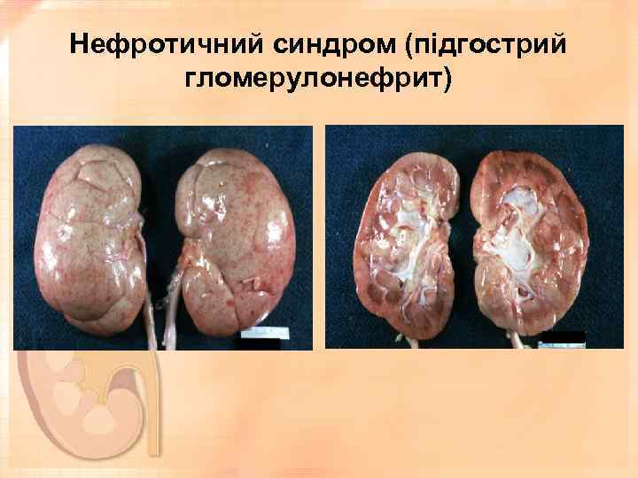 Нефротичний синдром (підгострий гломерулонефрит) 