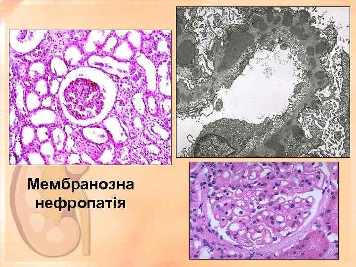 Мембранозна нефропатія 