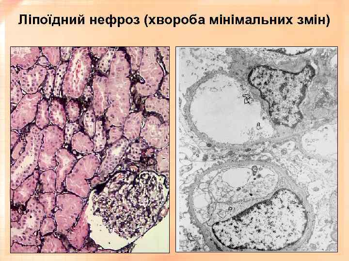 Ліпоїдний нефроз (хвороба мінімальних змін) 