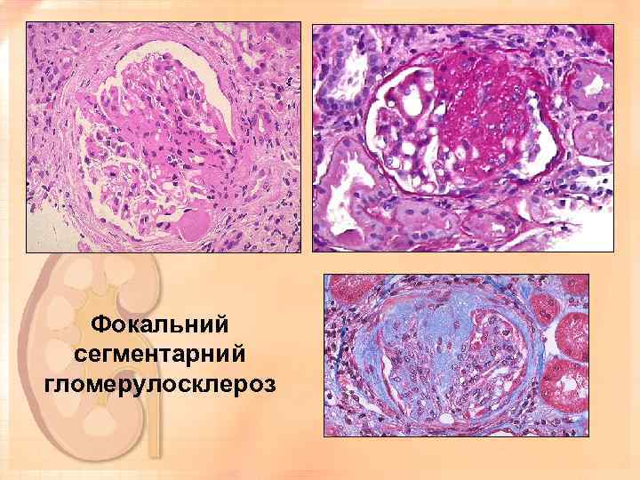 Фокальний сегментарний гломерулосклероз 