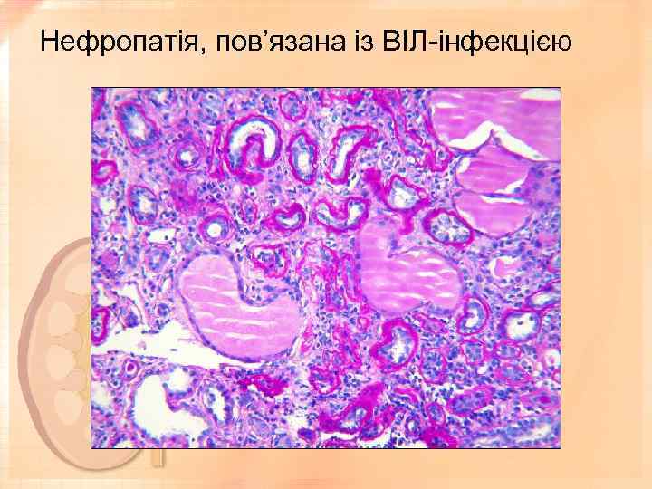 Нефропатія, пов’язана із ВІЛ-інфекцією 
