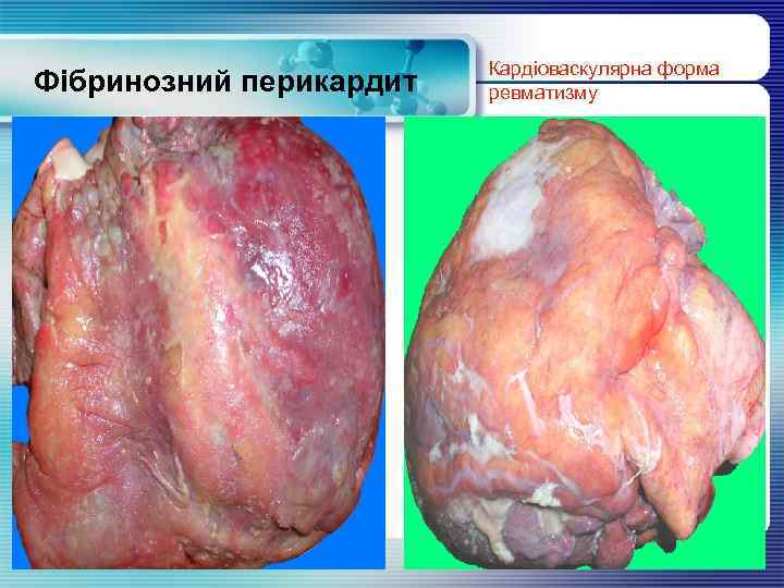 Фібринозний перикардит Кардіоваскулярна форма ревматизму www. themegallery. com 