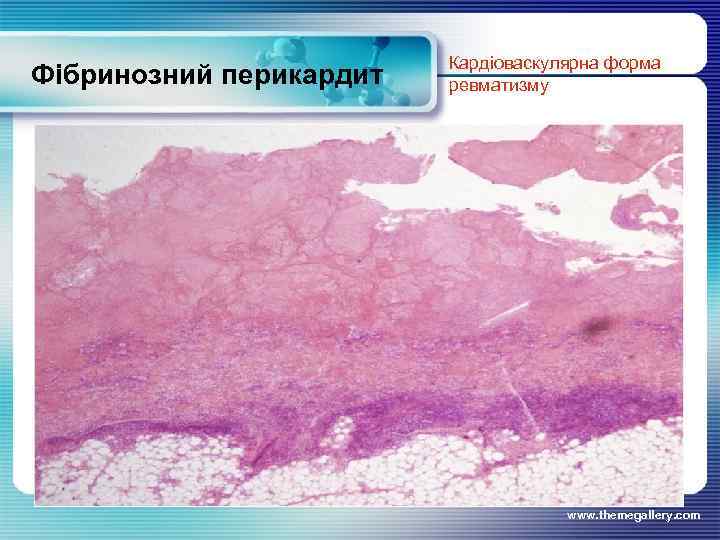 Фібринозний перикардит Кардіоваскулярна форма ревматизму www. themegallery. com 