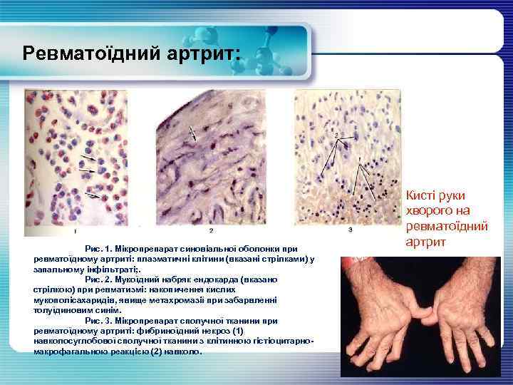 Ревматоїдний артрит: Рис. 1. Мікропрепарат синовіальної оболонки при ревматоїдному артриті: плазматичні клітини (вказані стрілками)