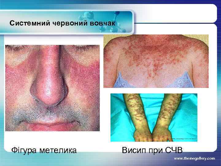 Системний червоний вовчак Фігура метелика Висип при СЧВ www. themegallery. com 