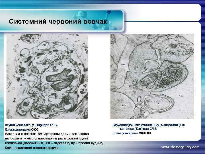 Системний червоний вовчак Імунні комплексі у шкірі при СЧВ. Електронограма. Х 900 Базальна мембрана(БМ)