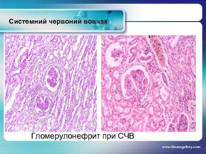 Системний червоний вовчак Гломерулонефрит при СЧВ www. themegallery. com 