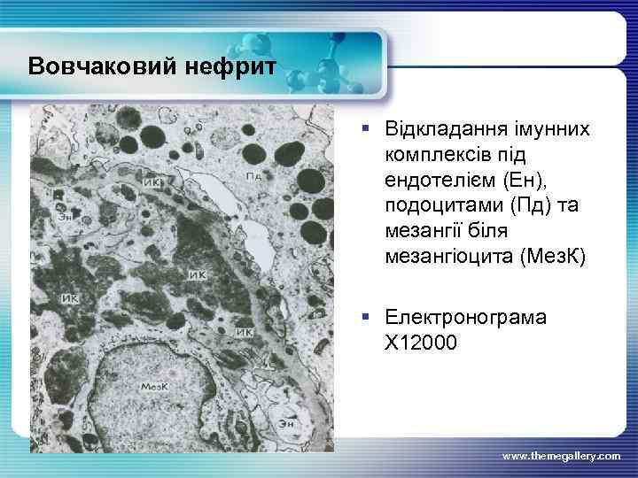 Вовчаковий нефрит § Відкладання імунних комплексів під ендотелієм (Ен), подоцитами (Пд) та мезангії біля