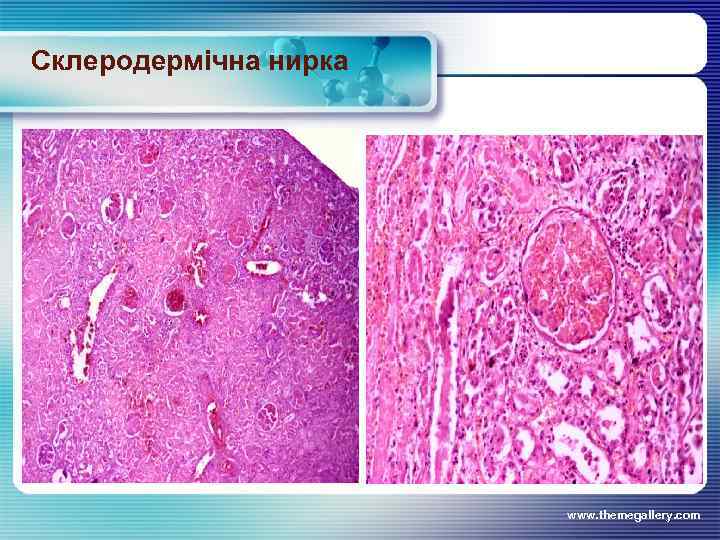 Склеродермічна нирка www. themegallery. com 