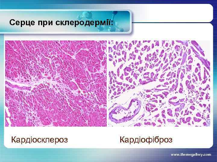 Серце при склеродермії: Кардіосклероз Кардіофіброз www. themegallery. com 