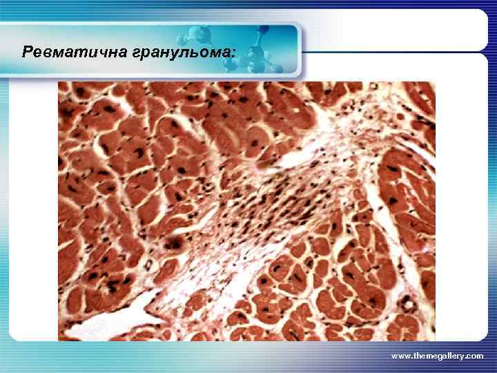 Ревматична гранульома: www. themegallery. com 