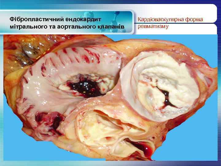 Фібропластичний ендокардит мітрального та аортального клапанів Кардіоваскулярна форма ревматизму www. themegallery. com 