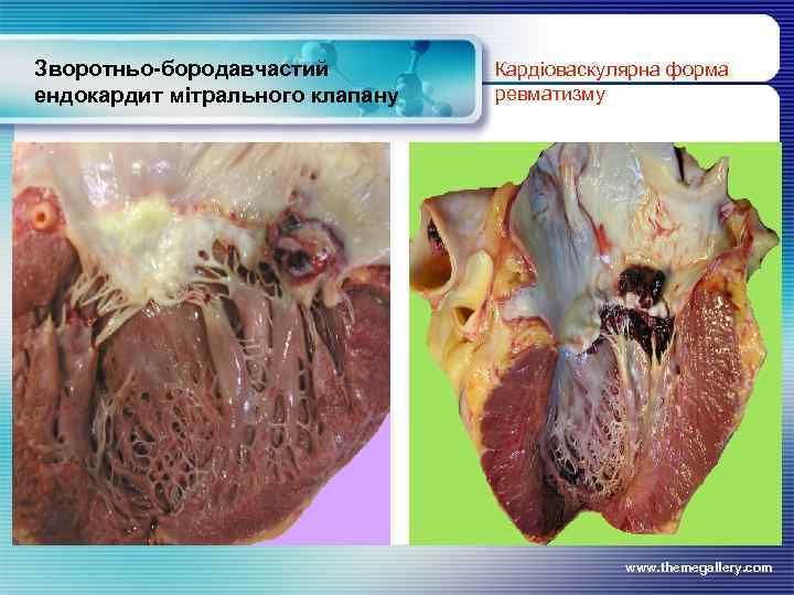 Зворотньо-бородавчастий ендокардит мітрального клапану Кардіоваскулярна форма ревматизму www. themegallery. com 