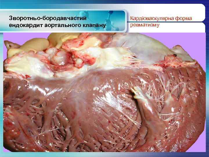 Зворотньо-бородавчастий ендокардит аортального клапану Кардіоваскулярна форма ревматизму www. themegallery. com 