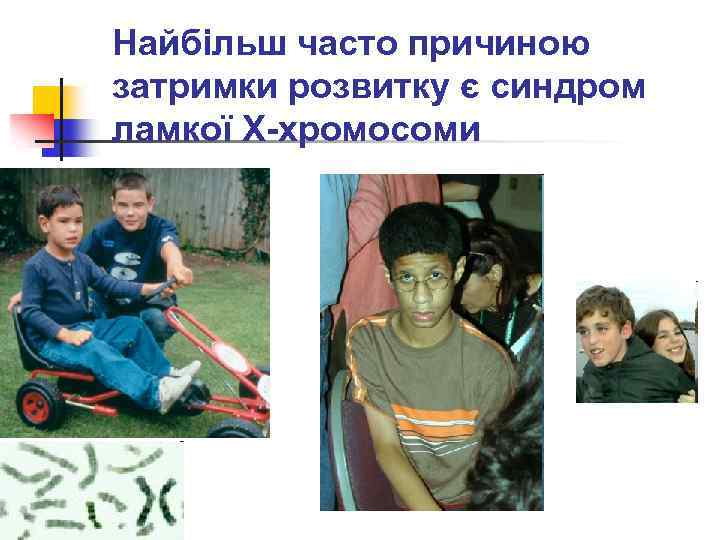 Найбільш часто причиною затримки розвитку є синдром ламкої Х-хромосоми 