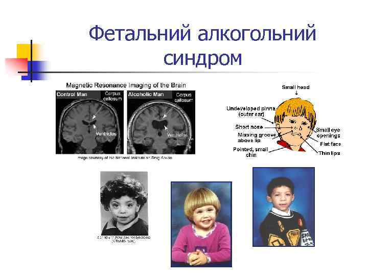 Фетальний алкогольний синдром 