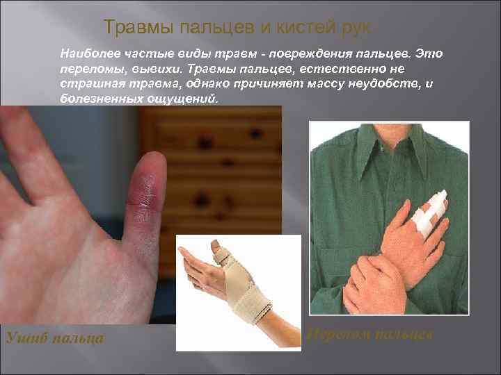 Травмы пальцев и кистей рук Наиболее частые виды травм - повреждения пальцев. Это переломы,