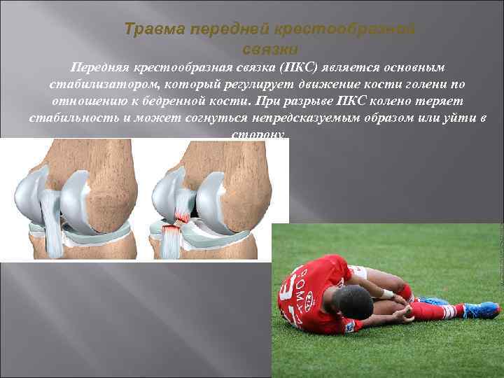 Травма передней крестообразной связки Передняя крестообразная связка (ПКС) является основным стабилизатором, который регулирует движение