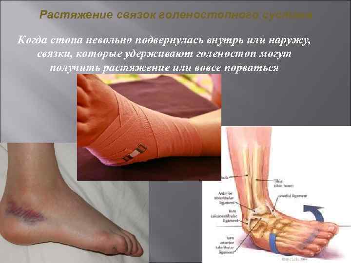 Растяжение связок голеностопного сустава Когда стопа невольно подвернулась внутрь или наружу, связки, которые удерживают