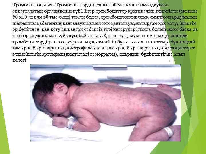 Тромбоцитопения- Тромбоциттердің саны 150 мың/мкл төмендеуімен сипатталатын организмнің күйі. Егер тромбоциттер критикалық деңгейден (меньше