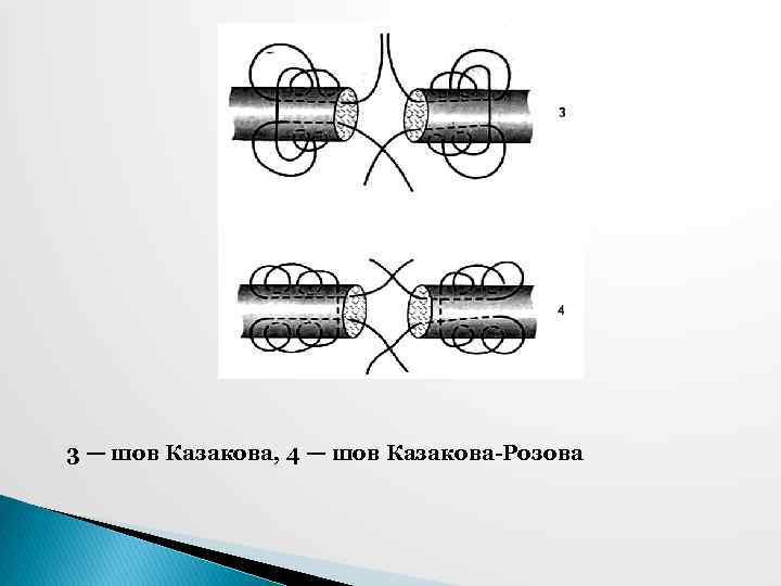 3 — шов Казакова, 4 — шов Казакова-Розова 