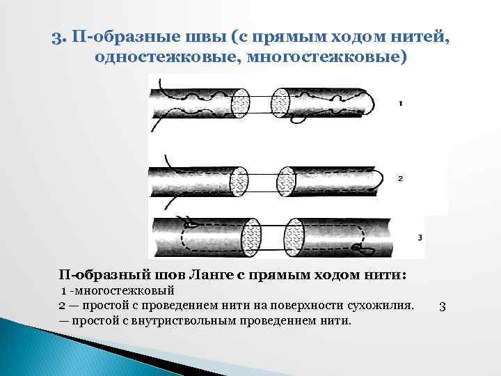 3. П-образные швы (с прямым ходом нитей, одностежковые, многостежковые) П-образный шов Ланге с прямым