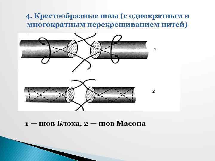 4. Крестообразные швы (с однократным и многократным перекрещиванием нитей) 1 — шов Блоха, 2