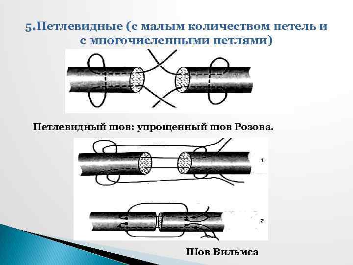 5. Петлевидные (с малым количеством петель и с многочисленными петлями) Петлевидный шов: упрощенный шов