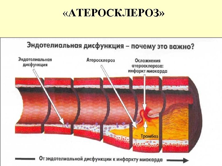 Атеросклероз бца картинки