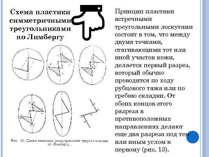 Пластика местными тканями презентация