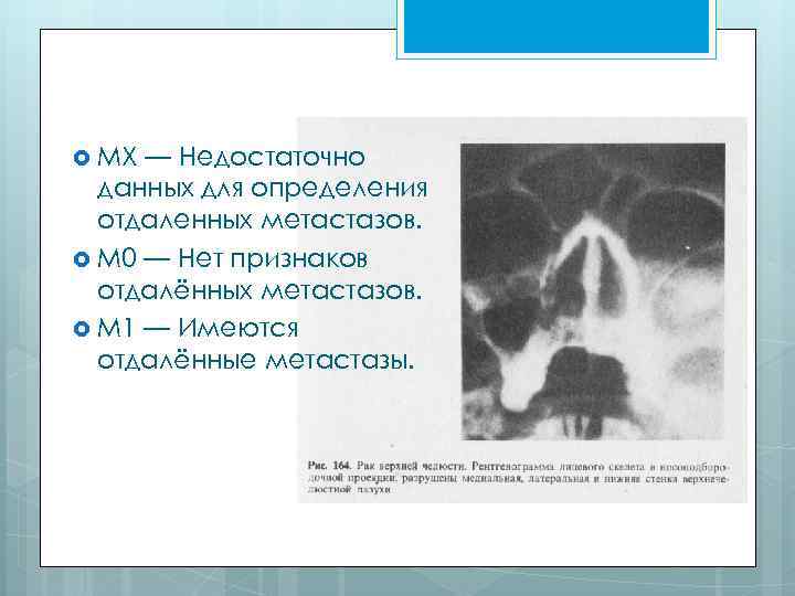  MX — Недостаточно данных для определения отдаленных метастазов. М 0 — Нет признаков