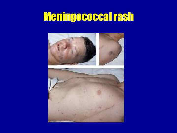 Meningococcal rash 