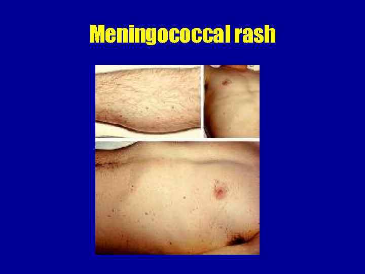 Meningococcal rash 