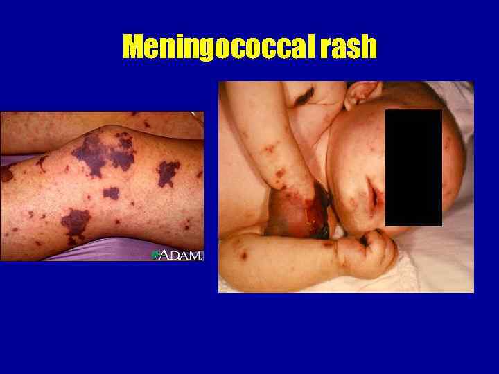 Meningococcal rash 