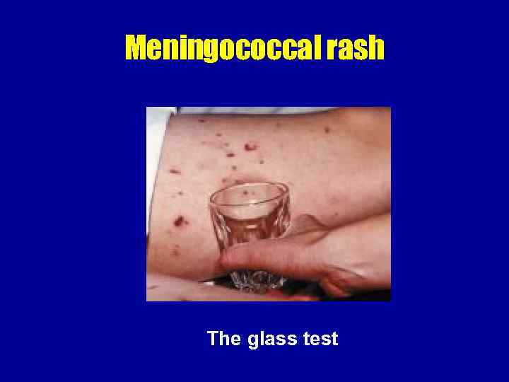 Meningococcal rash The glass test 