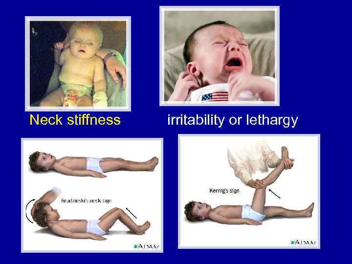 Neck stiffness irritability or lethargy 