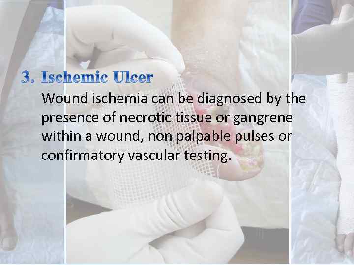 Wound ischemia can be diagnosed by the presence of necrotic tissue or gangrene within