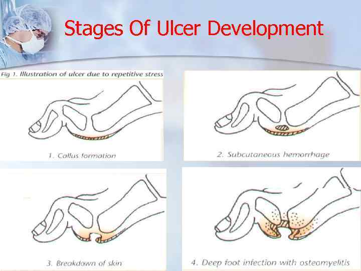 Stages Of Ulcer Development 