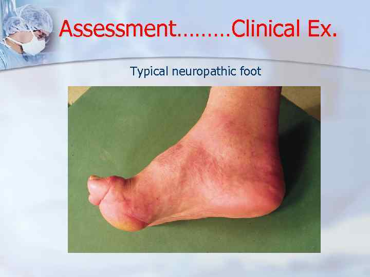 Assessment………Clinical Ex. Typical neuropathic foot 