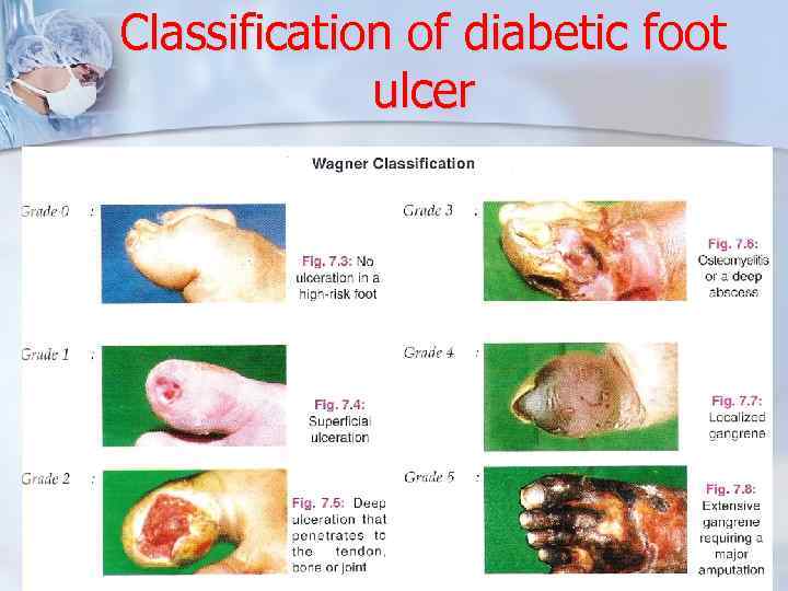 Classification of diabetic foot ulcer 