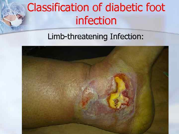 Classification of diabetic foot infection Limb-threatening Infection: 