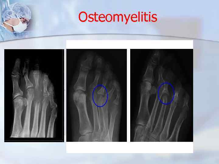 Osteomyelitis 