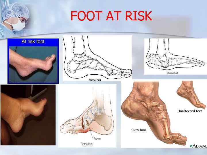 FOOT AT RISK 