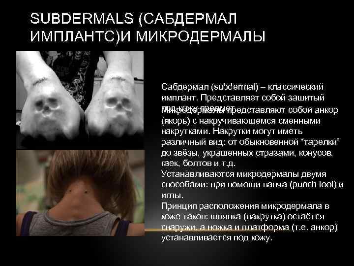 SUBDERMALS (САБДЕРМАЛ ИМПЛАНТС)И МИКРОДЕРМАЛЫ Сабдермал (subdermal) – классический имплант. Представляет собой зашитый под кожу