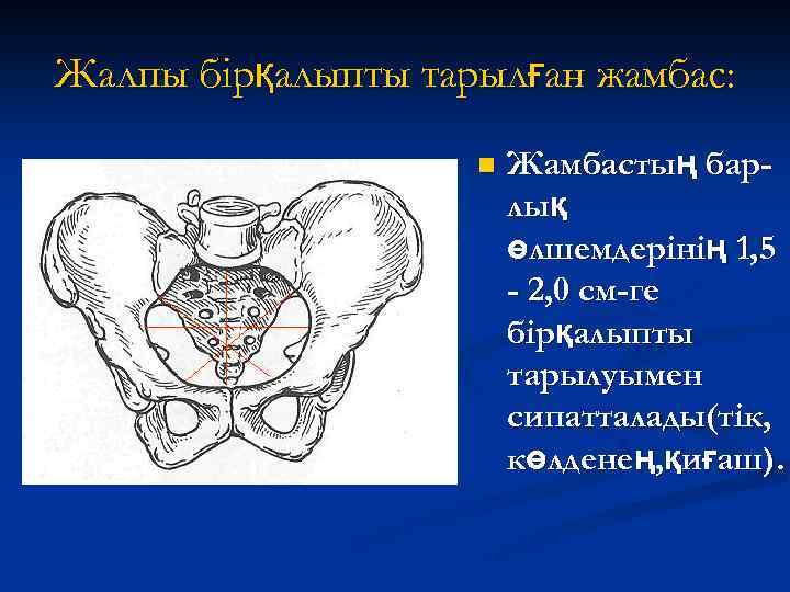 Жалпы бірқалыпты тарылған жамбас: n Жамбастың барлық өлшемдерінің 1, 5 - 2, 0 см-ге