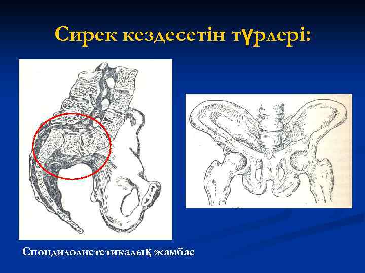 Сирек кездесетін түрлері: Спондилолистетикалық жамбас 