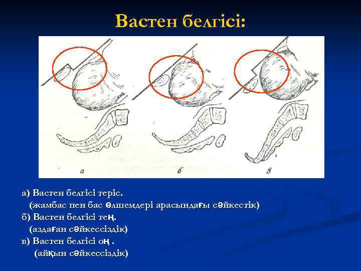 Вастен белгісі: а) Вастен белгісі теріс. (жамбас пен бас өлшемдері арасындағы сәйкестік) б) Вастен