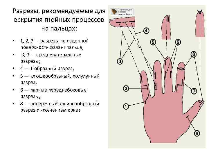 Разрезы, рекомендуемые для вскрытия гнойных процессов на пальцах: • • • 1, 2, 7