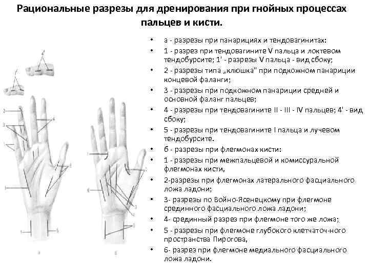 Рациональные разрезы для дренирования при гнойных процессах пальцев и кисти. • • • •