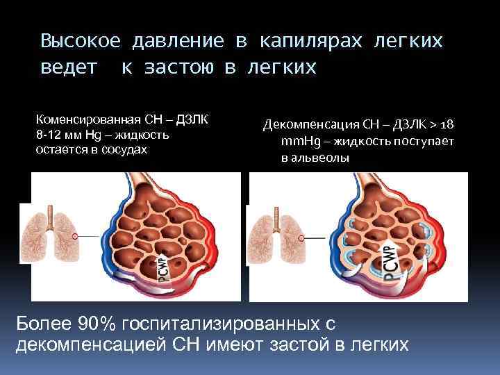 Высокое давление в капилярах легких ведет к застою в легких Коменсированная СН – ДЗЛК